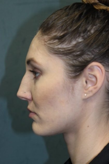 Rhinoplasty Before & After Patient #3710