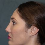 Rhinoplasty Before & After Patient #3710