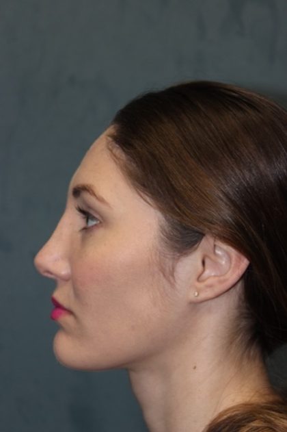 Rhinoplasty Before & After Patient #3710