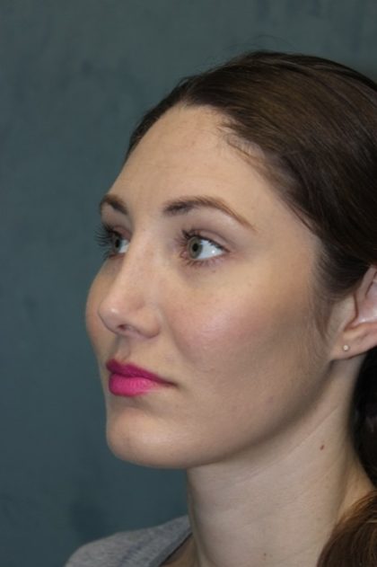 Rhinoplasty Before & After Patient #3710