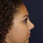 Rhinoplasty Before & After Patient #3927