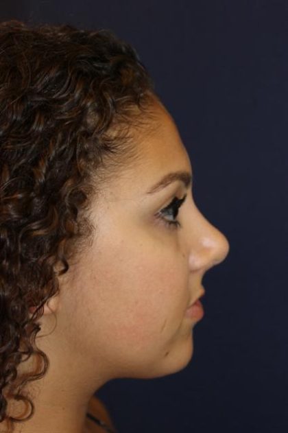 Rhinoplasty Before & After Patient #3927