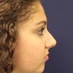 Rhinoplasty Before & After Patient #3927