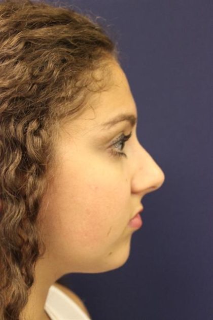 Rhinoplasty Before & After Patient #3927