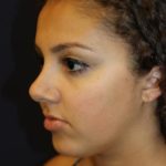 Rhinoplasty Before & After Patient #3927