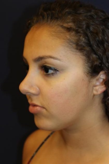 Rhinoplasty Before & After Patient #3927