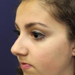 Rhinoplasty Before & After Patient #3927