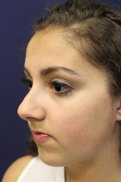 Rhinoplasty Before & After Patient #3927