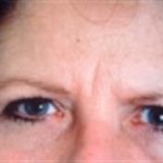 Browlift Before & After Patient #4698