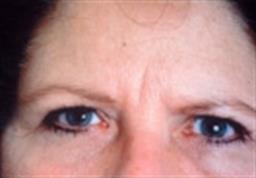 Browlift Before & After Patient #4698
