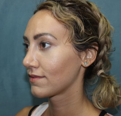Rhinoplasty Before & After Patient #3799
