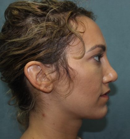 Rhinoplasty Before & After Patient #3799