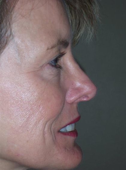 Rhinoplasty Before & After Patient #4077