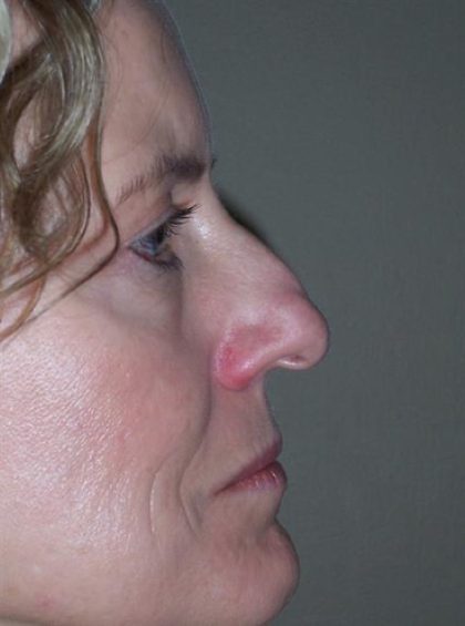 Rhinoplasty Before & After Patient #4077