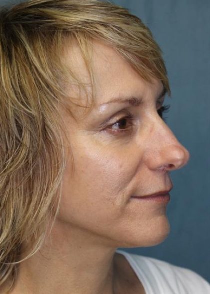 Rhinoplasty Before & After Patient #4038