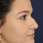Rhinoplasty Before & After Patient #4047