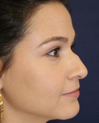 Rhinoplasty Before & After Patient #4047