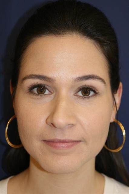 Rhinoplasty Before & After Patient #4047