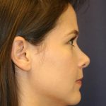 Rhinoplasty Before & After Patient #4047