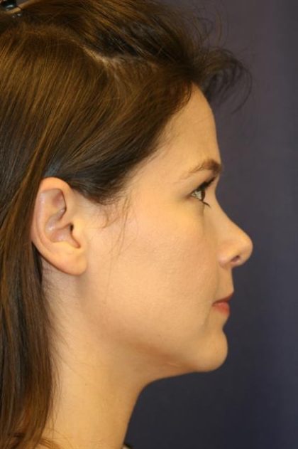 Rhinoplasty Before & After Patient #4047