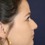 Rhinoplasty Before & After Patient #4047