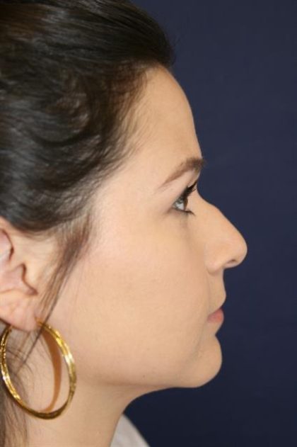 Rhinoplasty Before & After Patient #4047