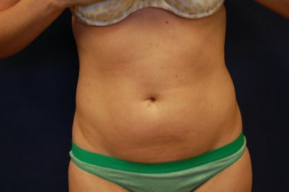 Liposuction Before & After Patient #4462