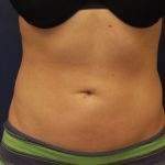 Liposuction Before & After Patient #4462