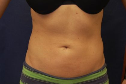 Liposuction Before & After Patient #4462