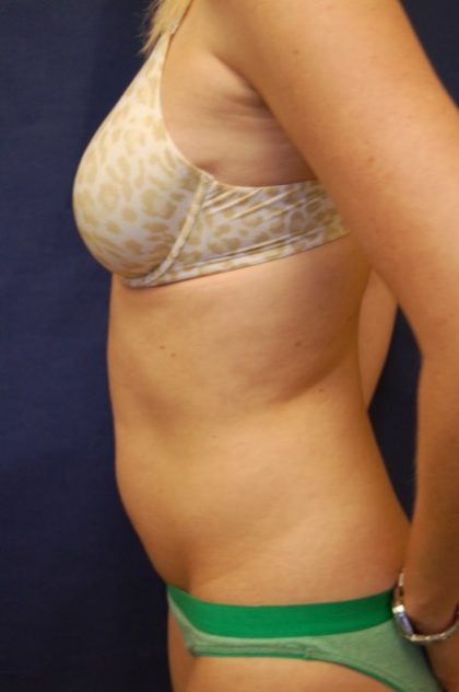 Liposuction Before & After Patient #4462