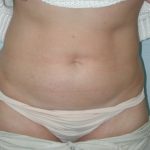 Liposuction Before & After Patient #4467
