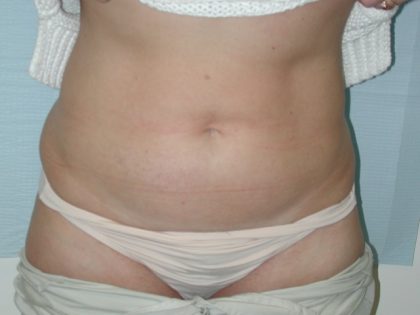 Liposuction Before & After Patient #4467