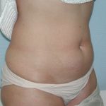 Liposuction Before & After Patient #4467