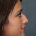 Rhinoplasty Before & After Patient #4138