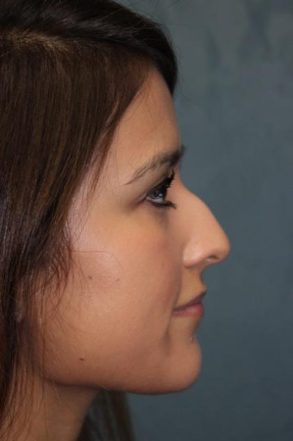 Rhinoplasty Before & After Patient #4138