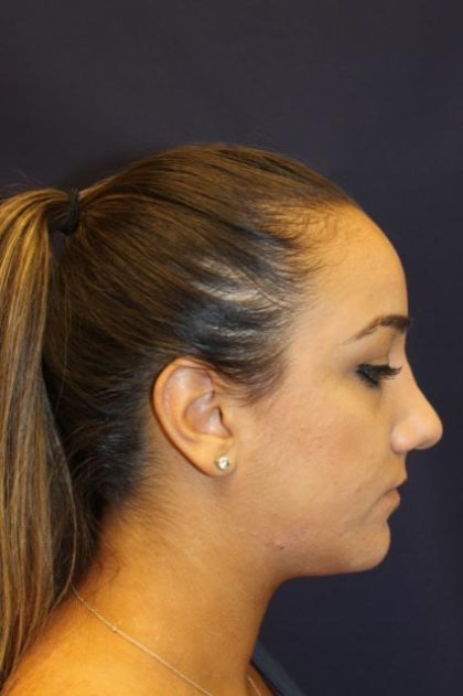 Rhinoplasty Before & After Patient #4163