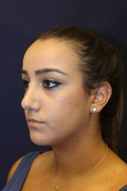 Rhinoplasty Before & After Patient #4163