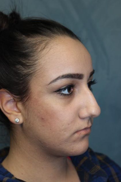 Rhinoplasty Before & After Patient #4163