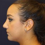 Rhinoplasty Before & After Patient #4163