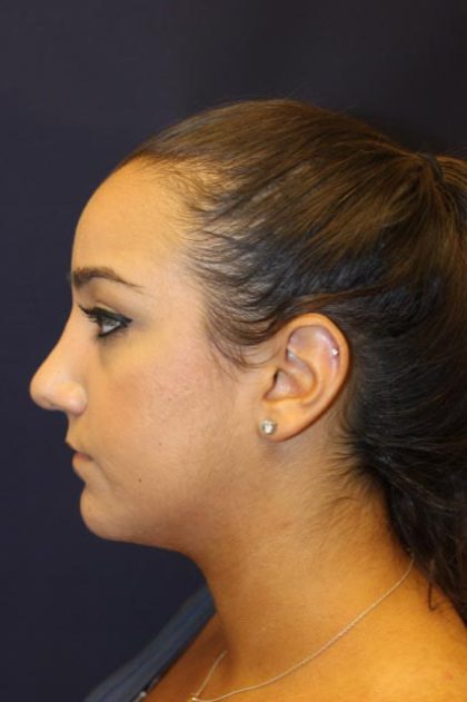 Rhinoplasty Before & After Patient #4163