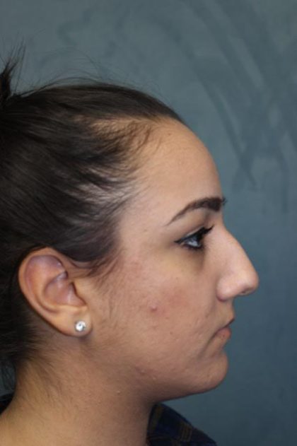 Rhinoplasty Before & After Patient #4163