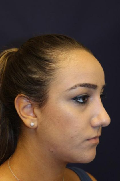 Rhinoplasty Before & After Patient #4163