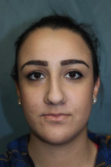 Rhinoplasty Before & After Patient #4163