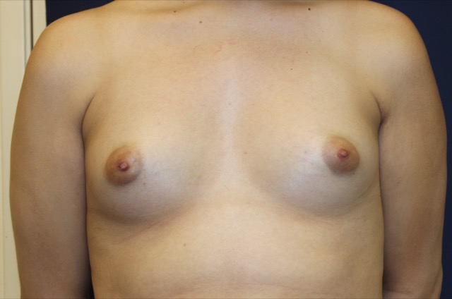 Breast Augmentation Before & After Patient #4762