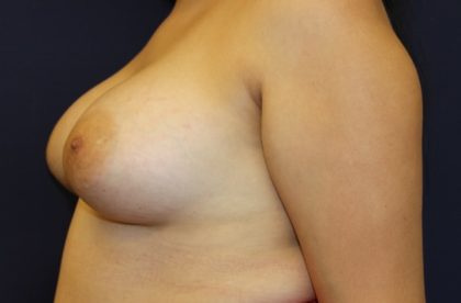 Breast Augmentation Before & After Patient #4762