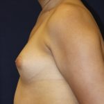 Breast Augmentation Before & After Patient #4762