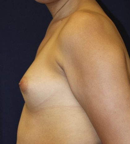 Breast Augmentation Before & After Patient #4762