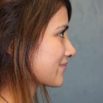 Rhinoplasty Before & After Patient #4138