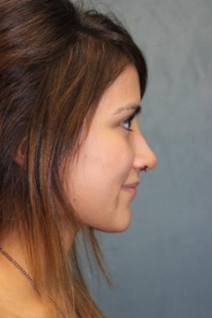 Rhinoplasty Before & After Patient #4138