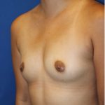 Breast Augmentation Before & After Patient #4784